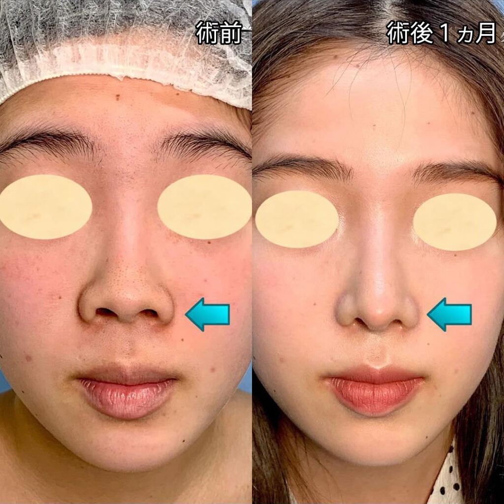 鼻尖形成と軟骨移植と鼻中隔延長とプロテーゼと鼻柱下降を同時に行った症例写真