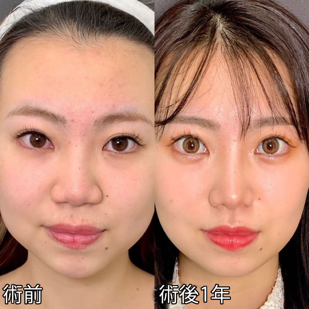 鼻尖形成と軟骨移植と鼻中隔延長と法令線基部人口真皮と鼻背部軟骨以上と小鼻縮小を同時に行った症例写真