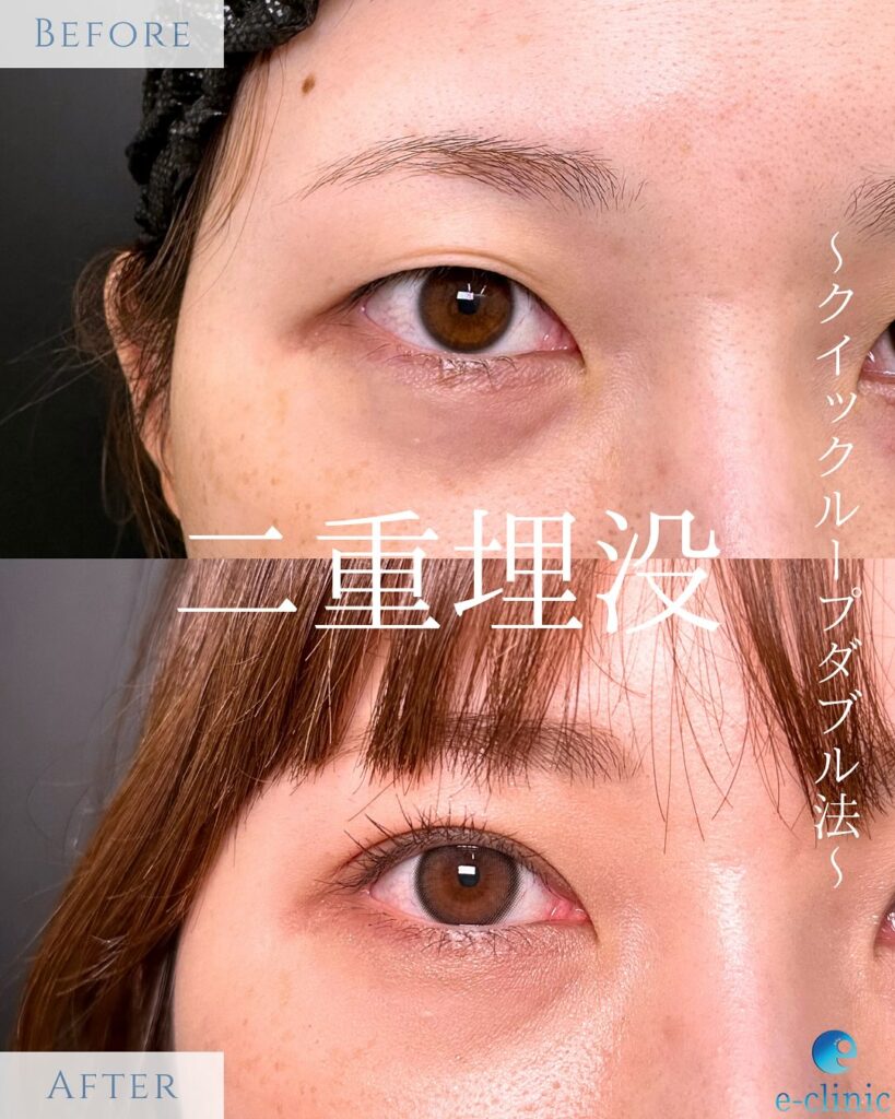 クイックループダブル法4点留めの症例写真 (1)