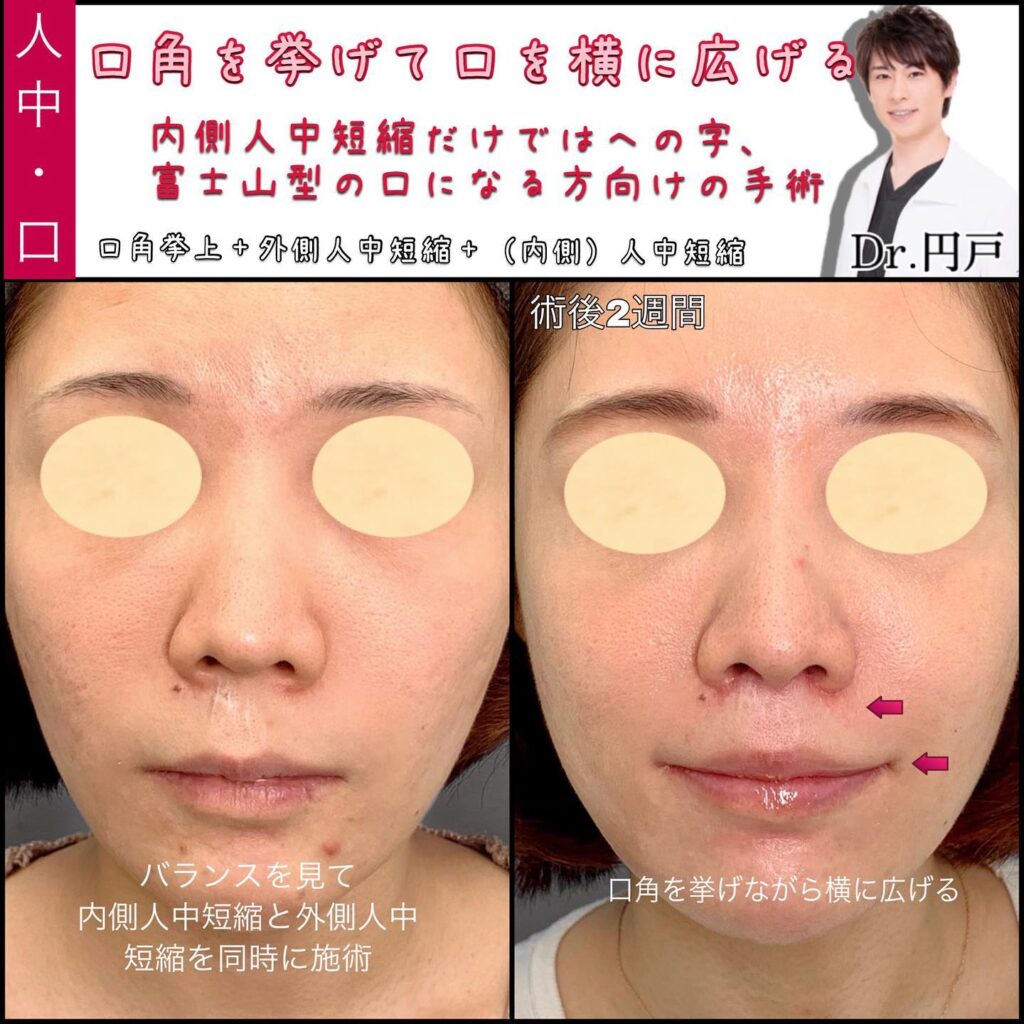 口角挙上と外側人中短縮と人中短縮の症例写真