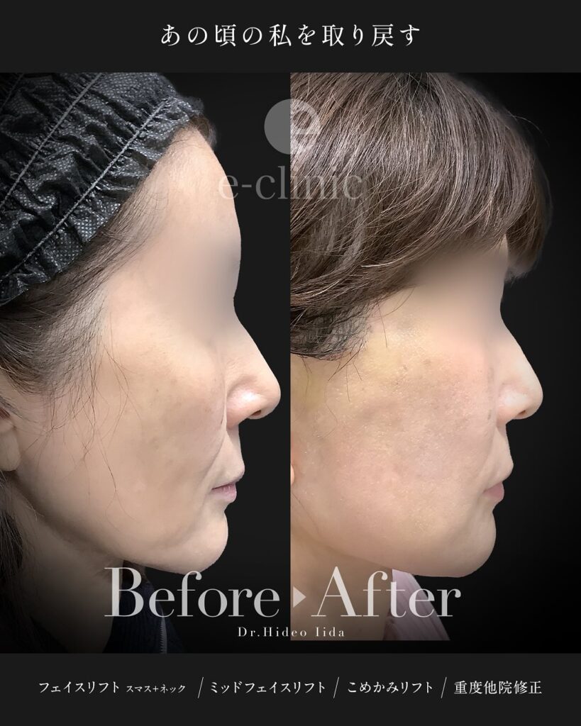 スマスフェイスリフトとネックリフトとミッドフェイスリフト(中顔面リフト)とこめかみリフトの症例写真 (3)
