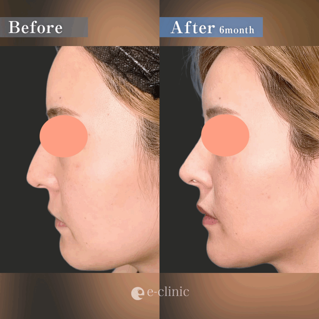 他院鼻修正術の症例写真 (2)