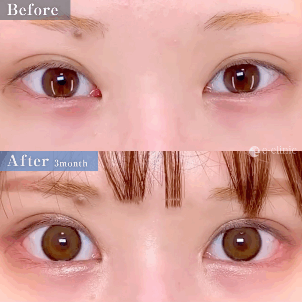 目尻切開とタレ目形成の他院修正の1か月後の症例