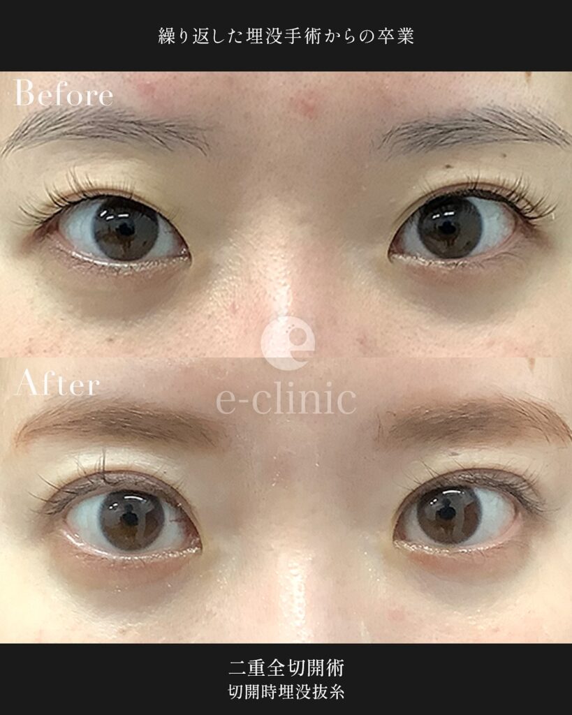 全切開法と埋没糸抜糸併用の症例写真 (2)