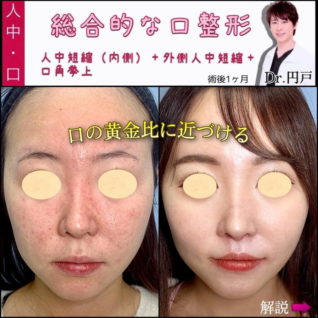 人中短縮と外側人中短縮と口角挙上の症例写真 (2)