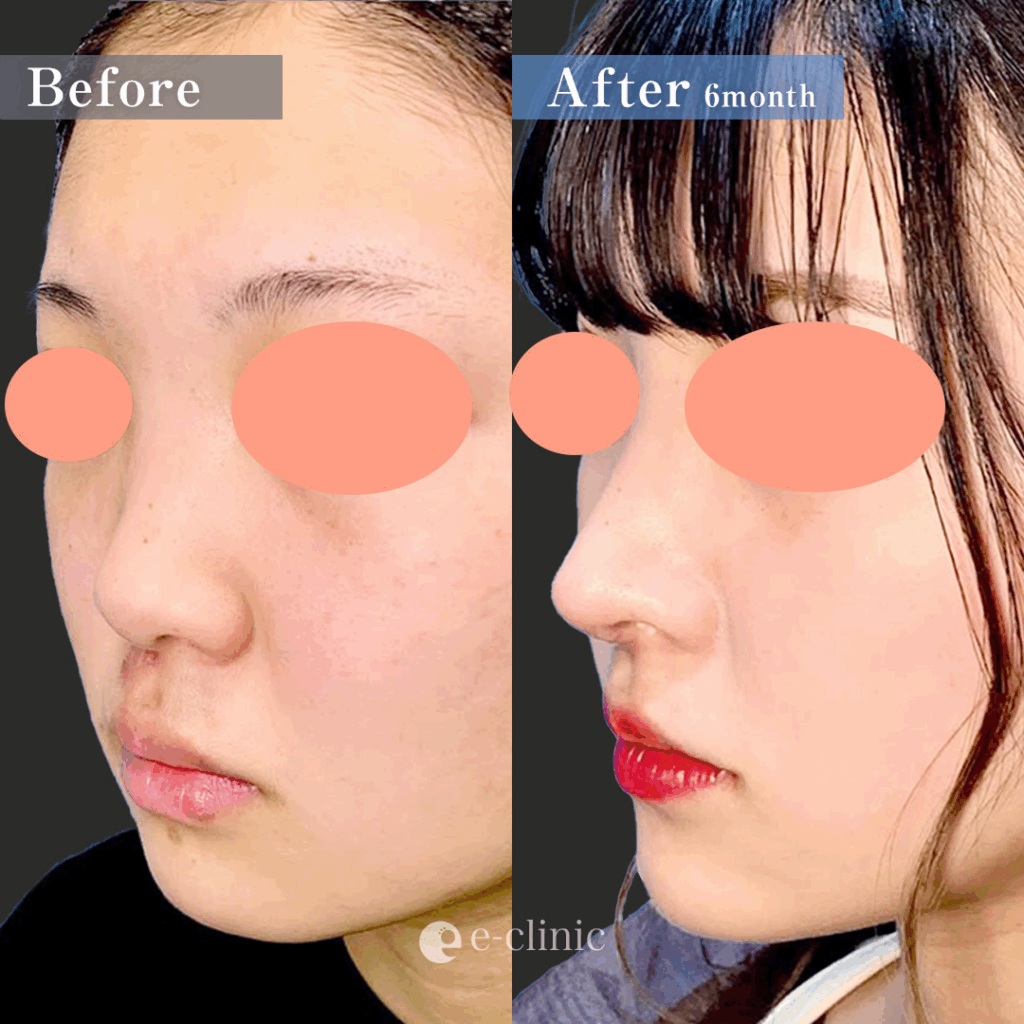 鼻尖形成と軟骨移植と鼻中隔延長と顎下の脂肪吸引の症例写真