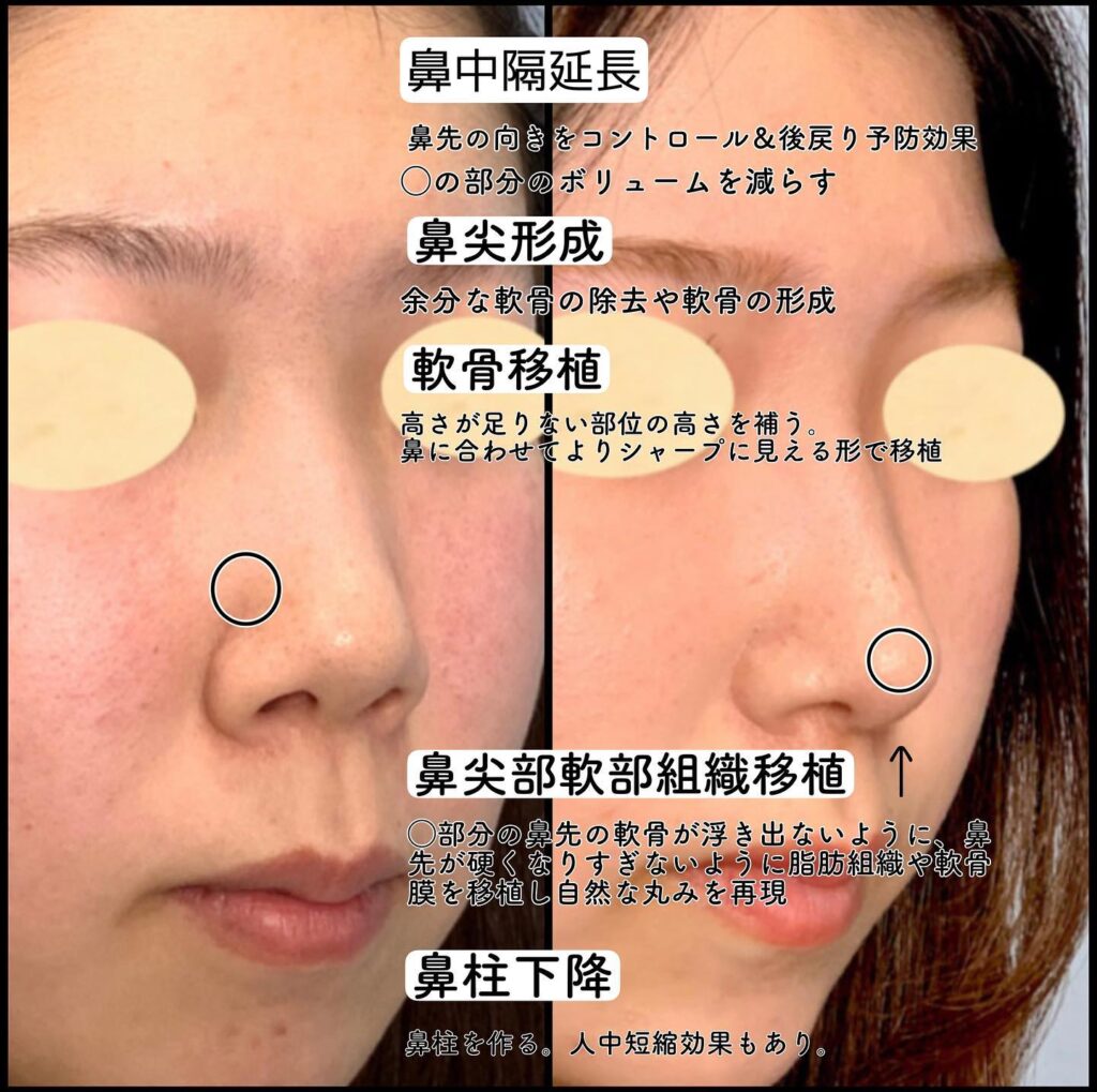 鼻中隔延長耳介と鼻背軟骨移植と鼻尖形成と軟骨移植とメーラーファットと頬と顎下の脂肪吸引と顎のヒアルロン酸の症例写真 (2)