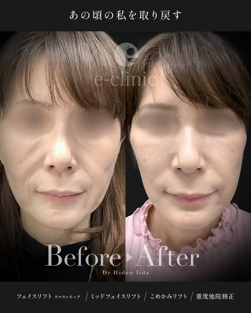 スマスフェイスリフトとネックリフトとミッドフェイスリフト(中顔面リフト)とこめかみリフトの症例写真 (2)
