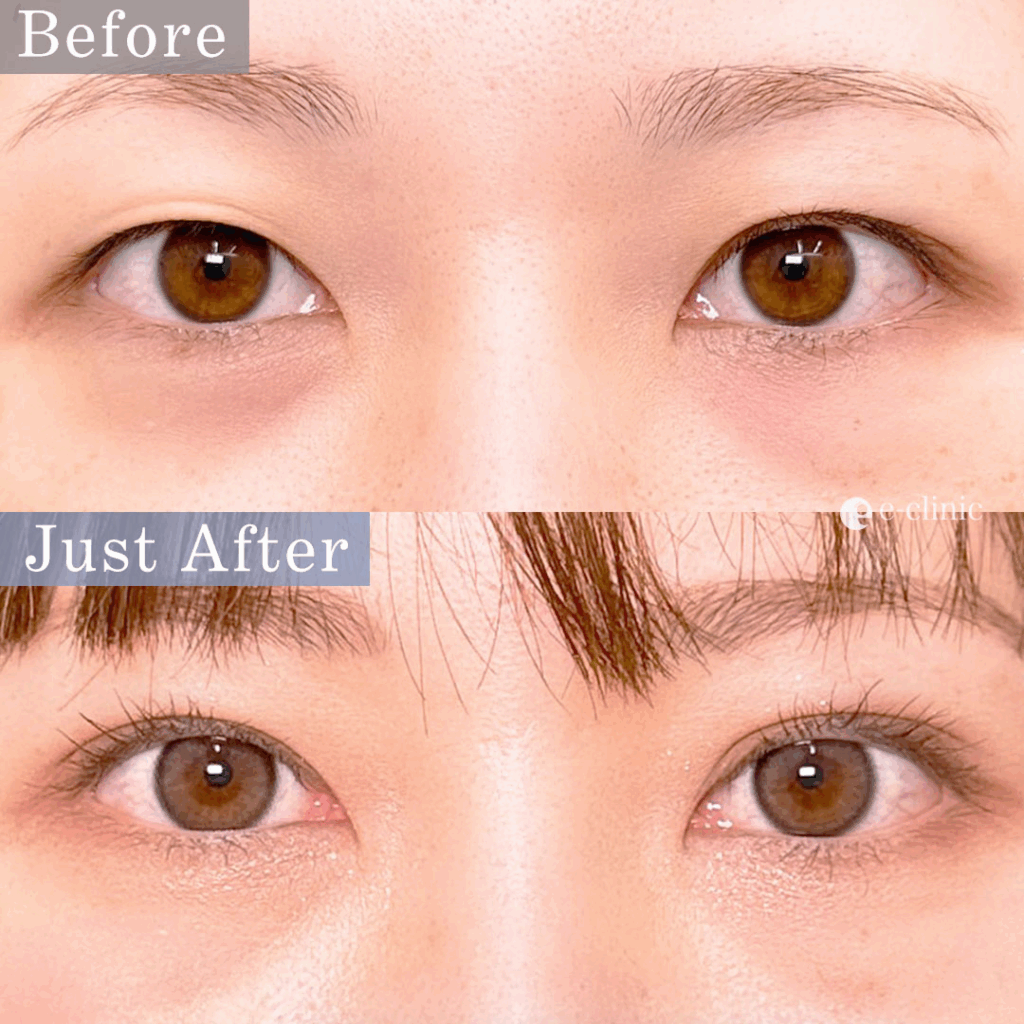 クイックループダブル法4点留めの症例写真 (2)