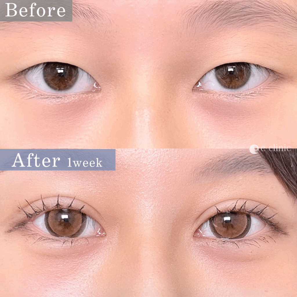 埋没法(自然癒着法)の症例写真