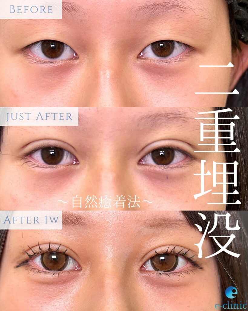 埋没法(自然癒着法)の症例写真