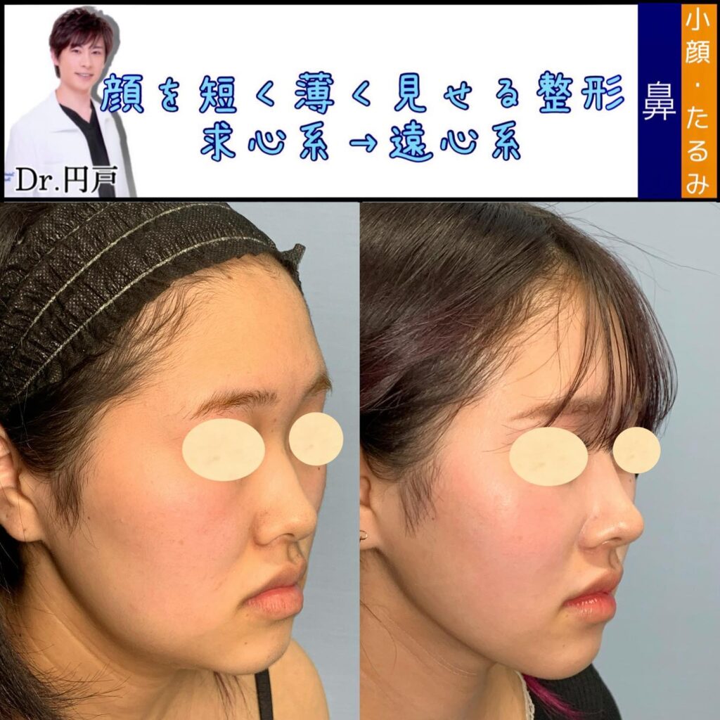 目尻切開と目尻靭帯移動とタレ目形成と眉下切開と鼻のプロテーゼと鼻尖形成と軟骨移植と鼻中隔延長と小顔脂肪吸引と脂肪注入と糸リフトと貴族手術の症例写真 (1)