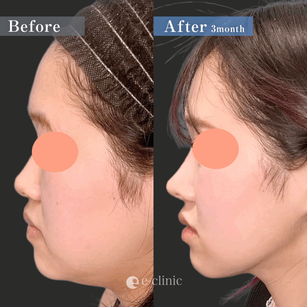 目尻切開と目尻靭帯移動とタレ目形成と眉下切開と鼻のプロテーゼと鼻尖形成と軟骨移植と鼻中隔延長と小顔脂肪吸引と脂肪注入と糸リフトと貴族手術の症例写真 (1)