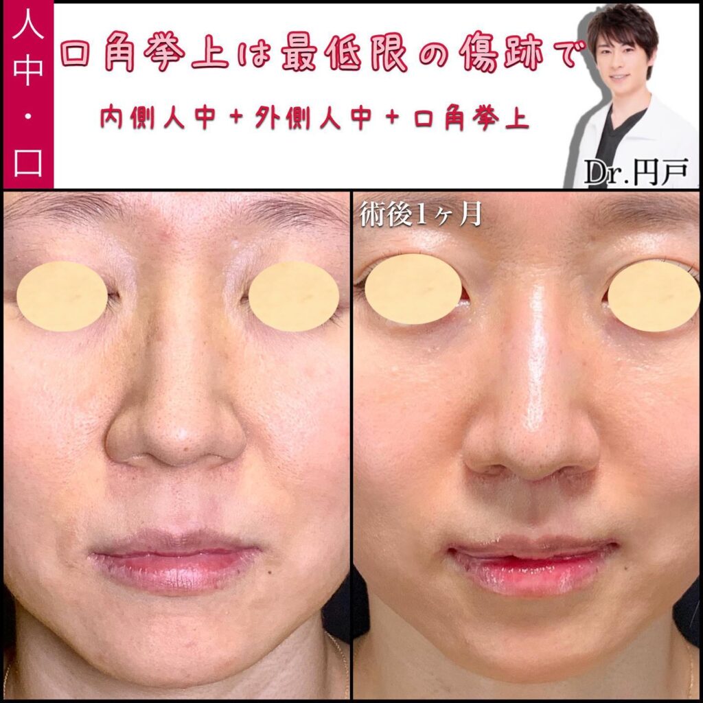 人中短縮と外側人中短縮と口角挙上の症例写真