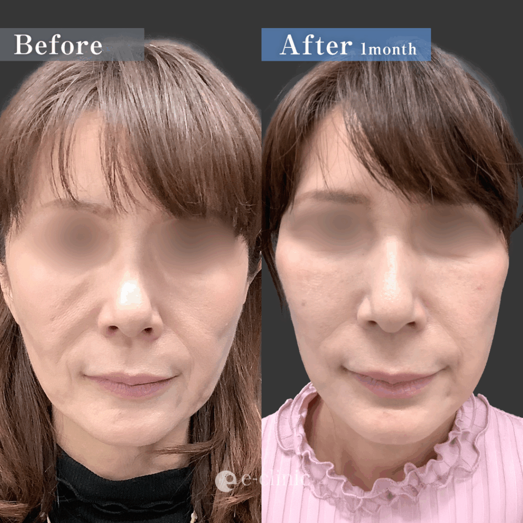 スマスフェイスリフトとネックリフトとミッドフェイスリフト(中顔面リフト)とこめかみリフトの症例写真 (1)