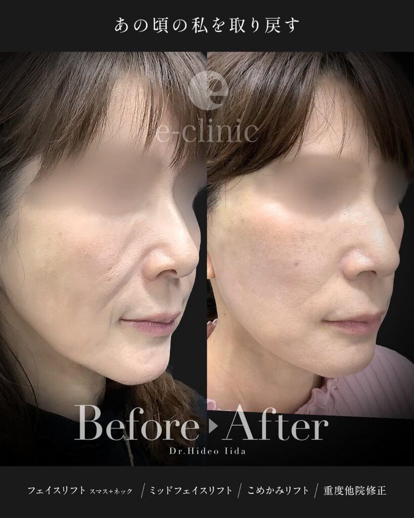 スマスフェイスリフトとネックリフトとミッドフェイスリフト(中顔面リフト)とこめかみリフトの症例写真 (1)