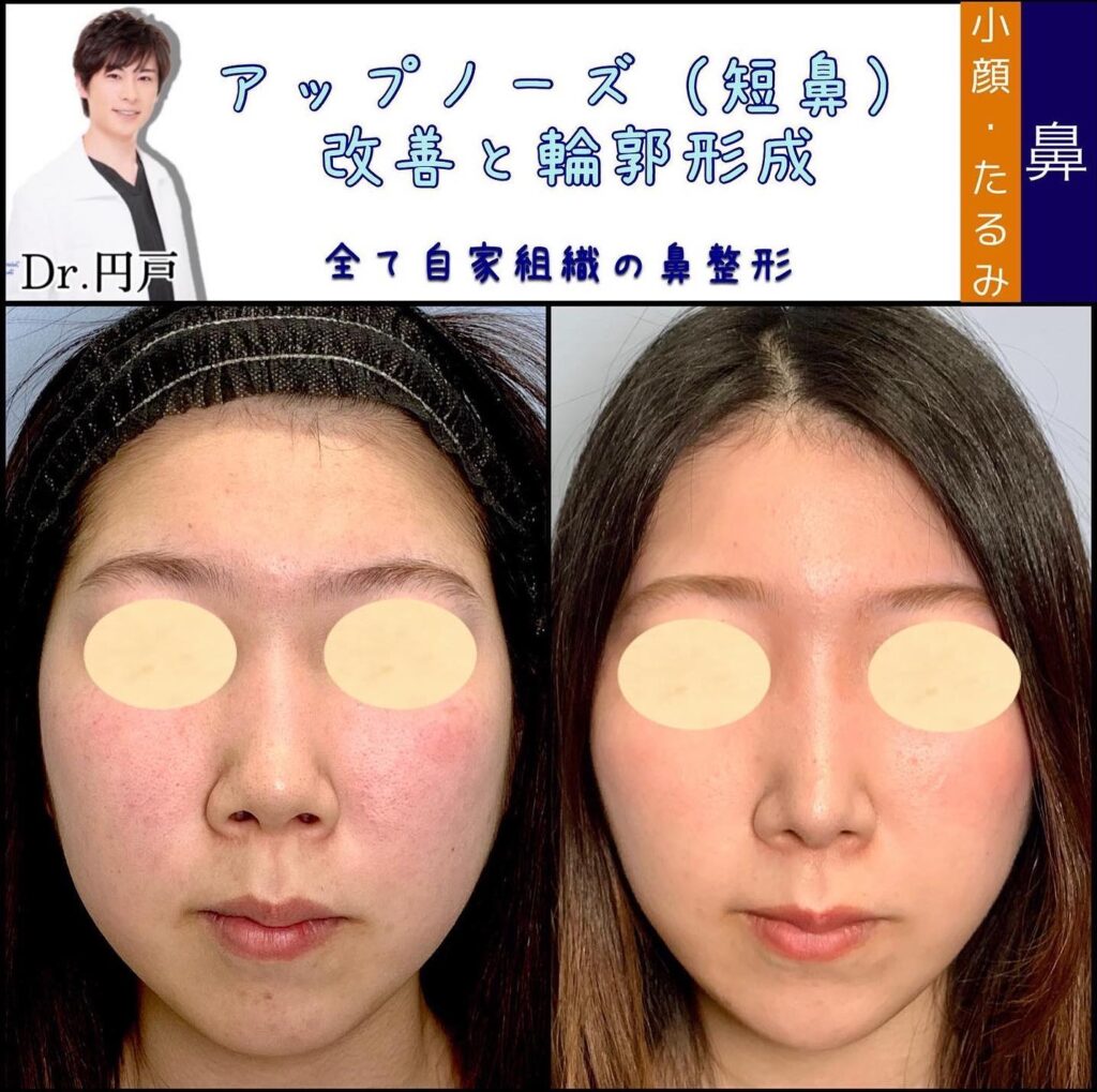 鼻中隔延長耳介と鼻背軟骨移植と鼻尖形成と軟骨移植とメーラーファットと頬と顎下の脂肪吸引と顎のヒアルロン酸の症例写真 (3)