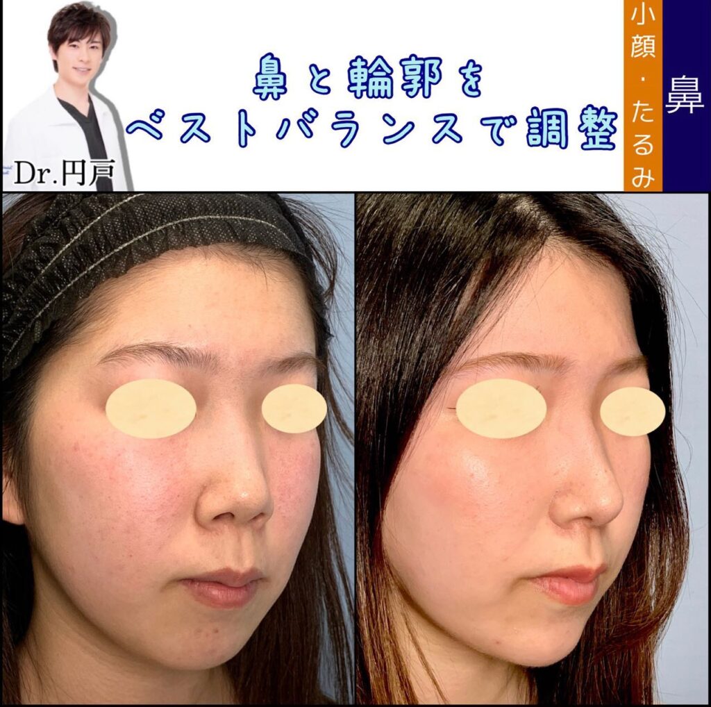 鼻中隔延長耳介と鼻背軟骨移植と鼻尖形成と軟骨移植とメーラーファットと頬と顎下の脂肪吸引と顎のヒアルロン酸の症例写真 (1)