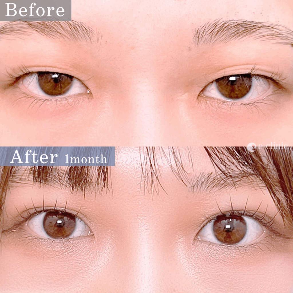 埋没法(自然癒着法)の症例写真 (2)