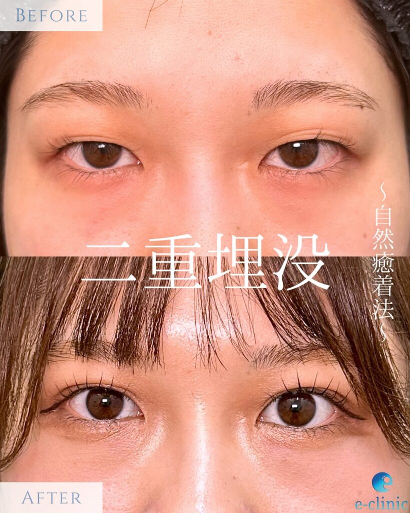 埋没法(自然癒着法)の症例写真 (2)