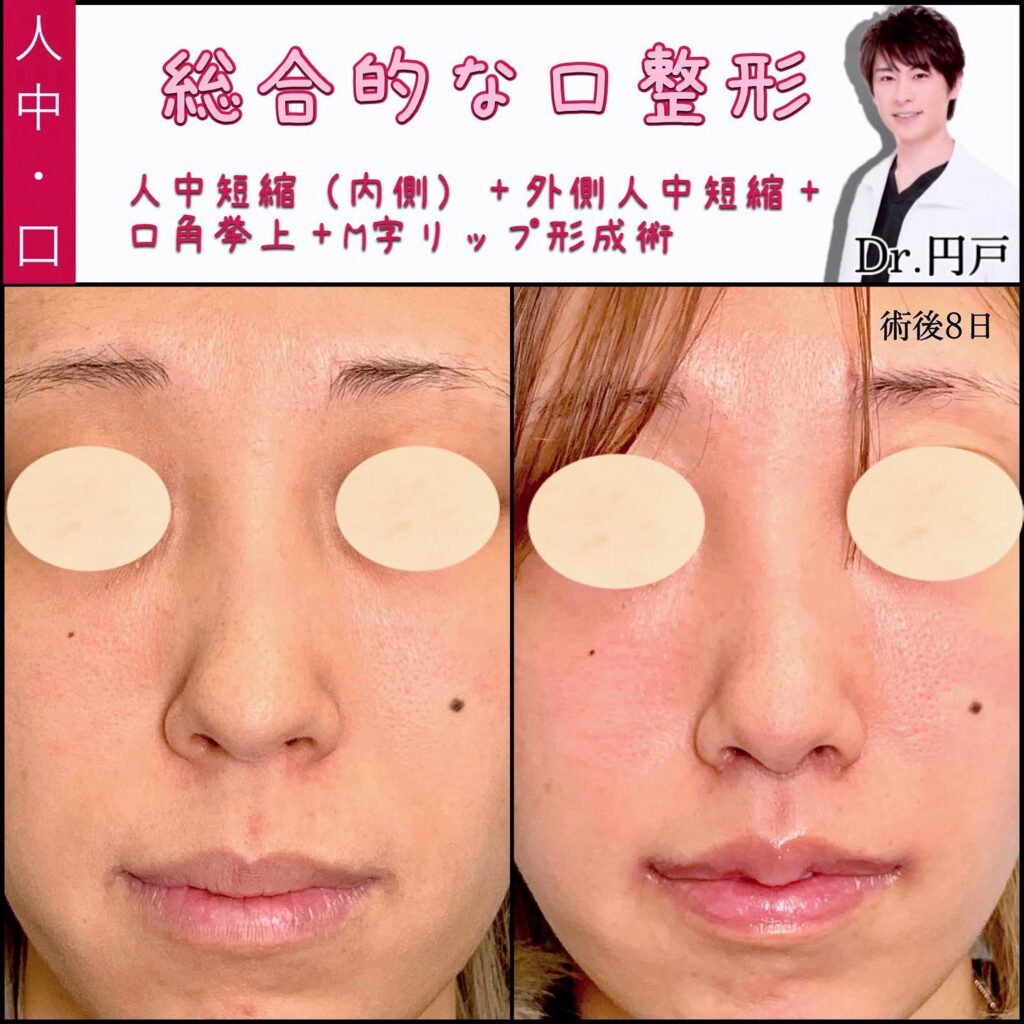 人中短縮と外側人中短縮と口角挙上とM字リップの症例写真