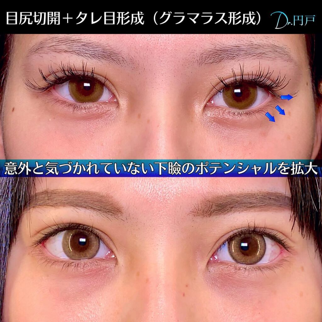 目尻切開(目尻靭帯移動)とタレ目(グラマラス)形成の症例写真