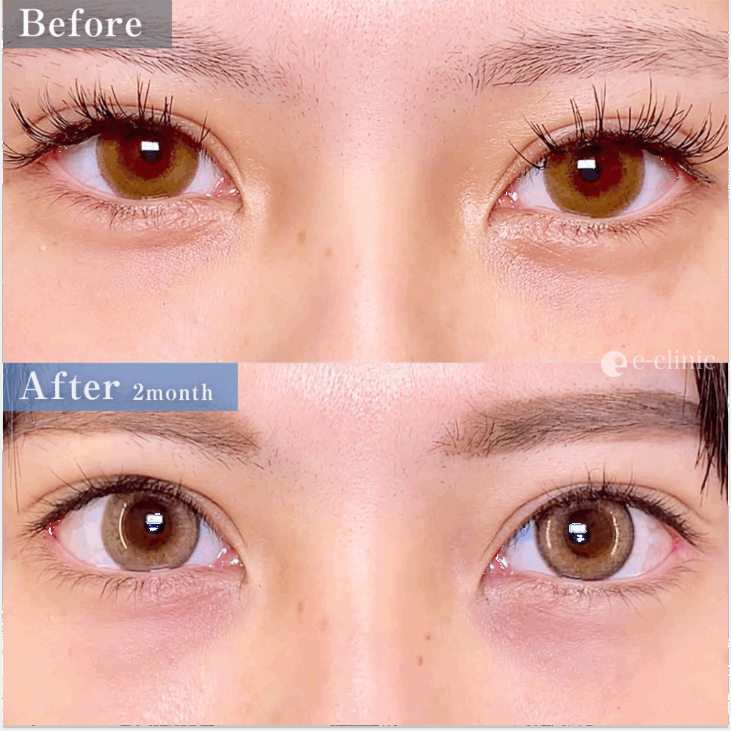 目尻切開(目尻靭帯移動)とタレ目(グラマラス)形成の症例写真