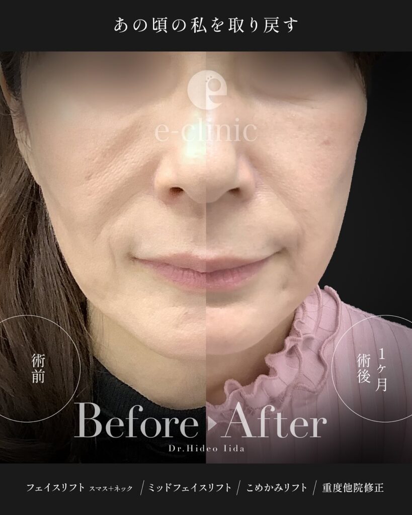 スマスフェイスリフトとネックリフトとミッドフェイスリフト(中顔面リフト)とこめかみリフトの症例写真 (4)