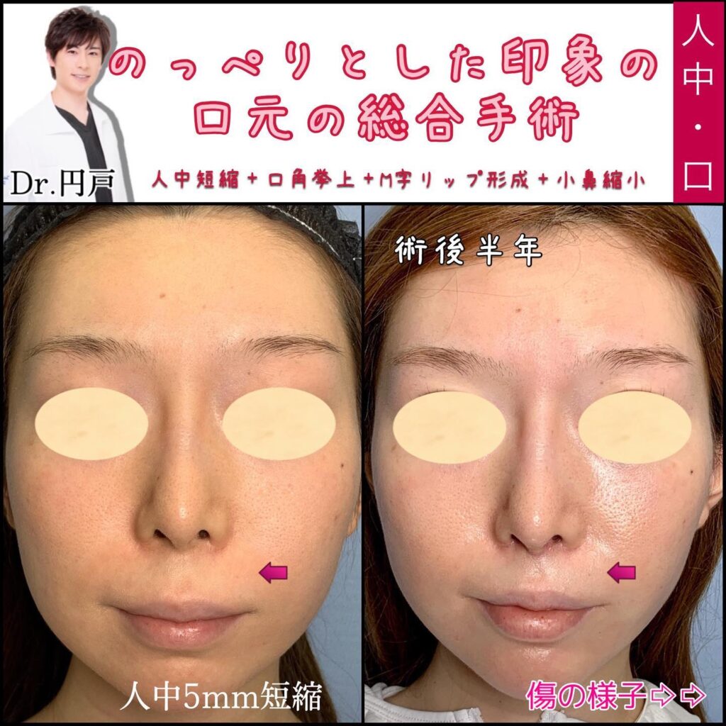 人中短縮と口角挙上とＭ字リップと小鼻縮小の症例写真