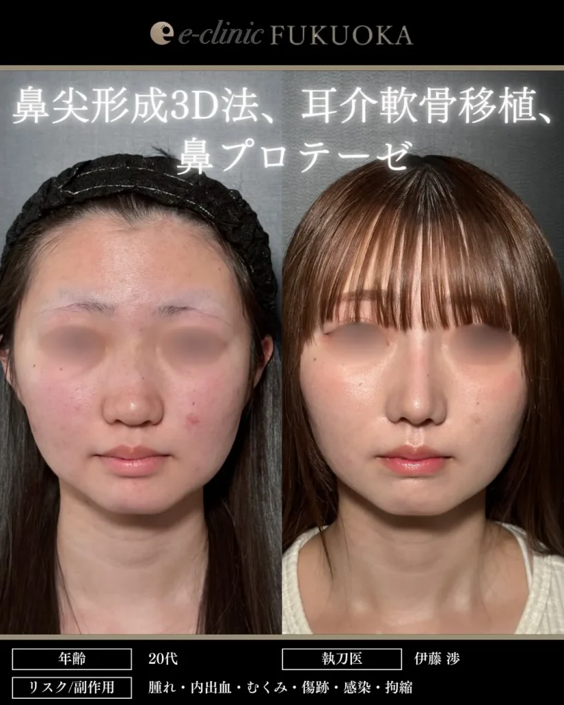 鼻整形（鼻フル）鼻尖形成と耳介軟骨移植と鼻のプロテーゼの症例写真（名医のeクリニック伊藤渉医師が執刀）
