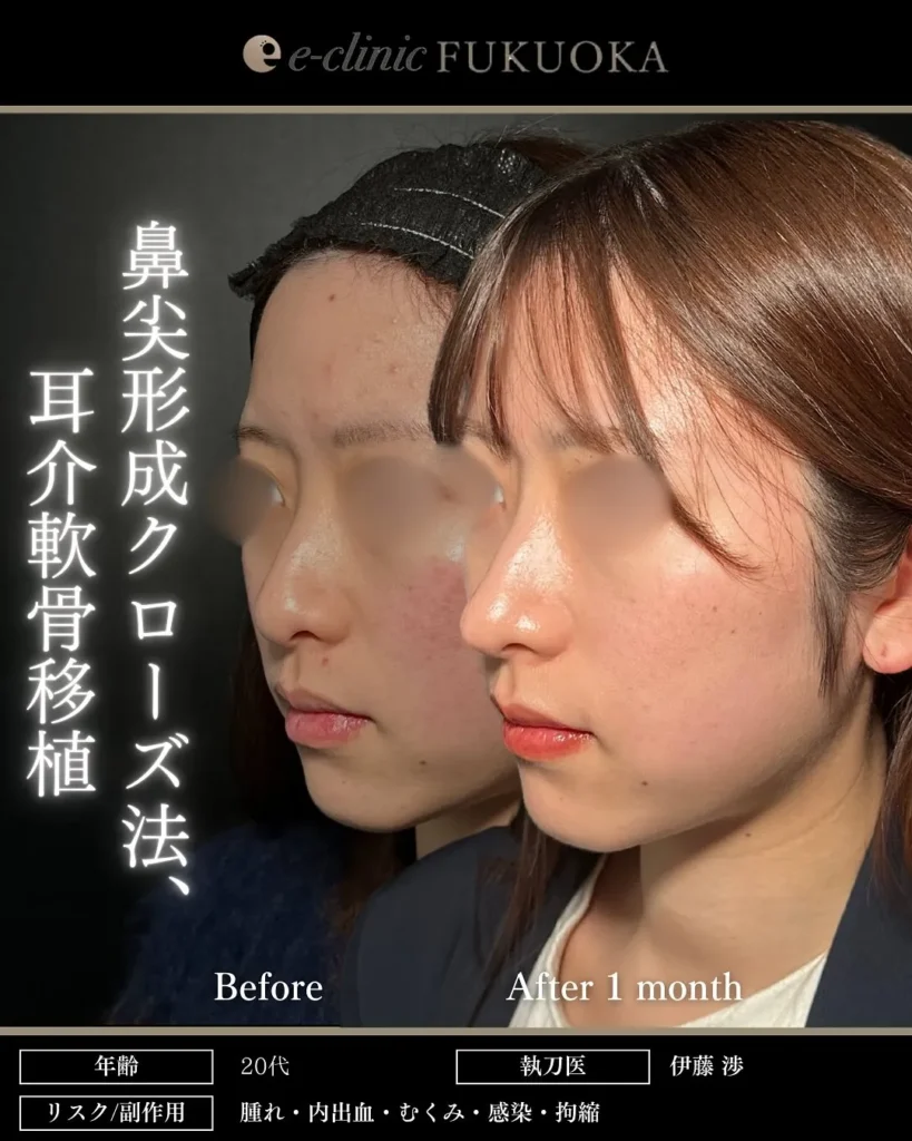 鼻整形（鼻フル）鼻尖形成と軟骨移植の症例写真（名医のeクリニック伊藤渉医師が執刀）