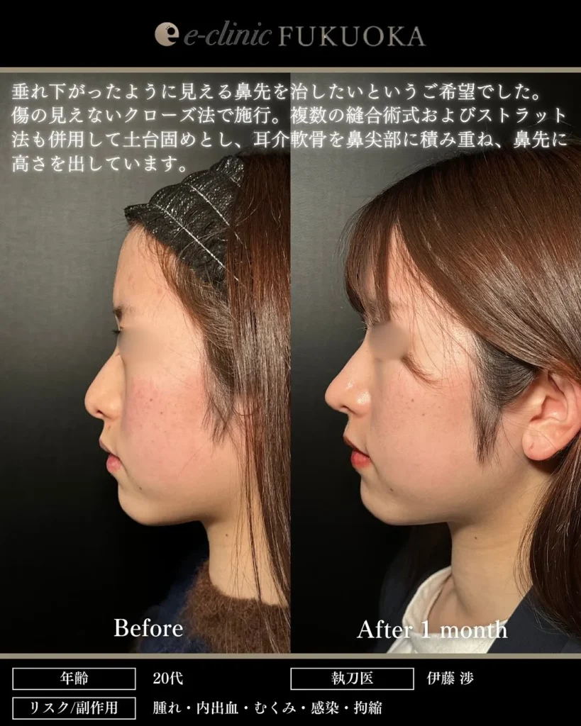 鼻整形（鼻フル）鼻尖形成と軟骨移植の症例写真（名医のeクリニック伊藤渉医師が執刀）
