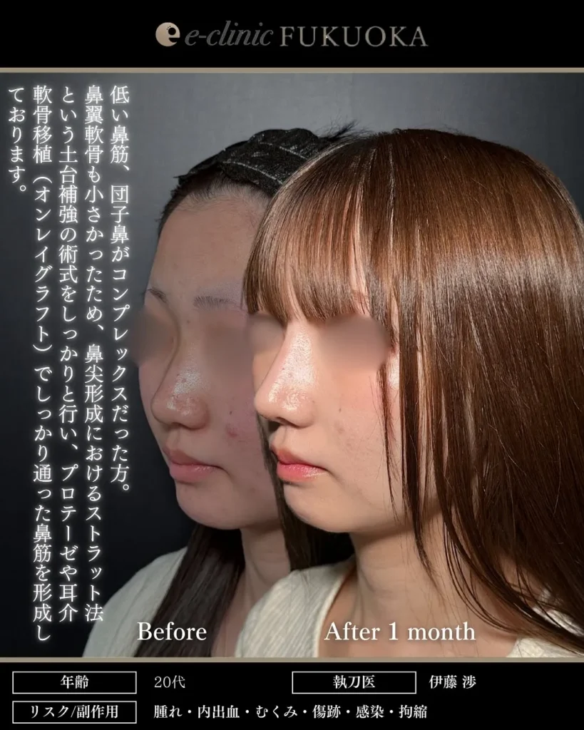 鼻整形（鼻フル）鼻尖形成と耳介軟骨移植と鼻のプロテーゼの症例写真（名医のeクリニック伊藤渉医師が執刀）