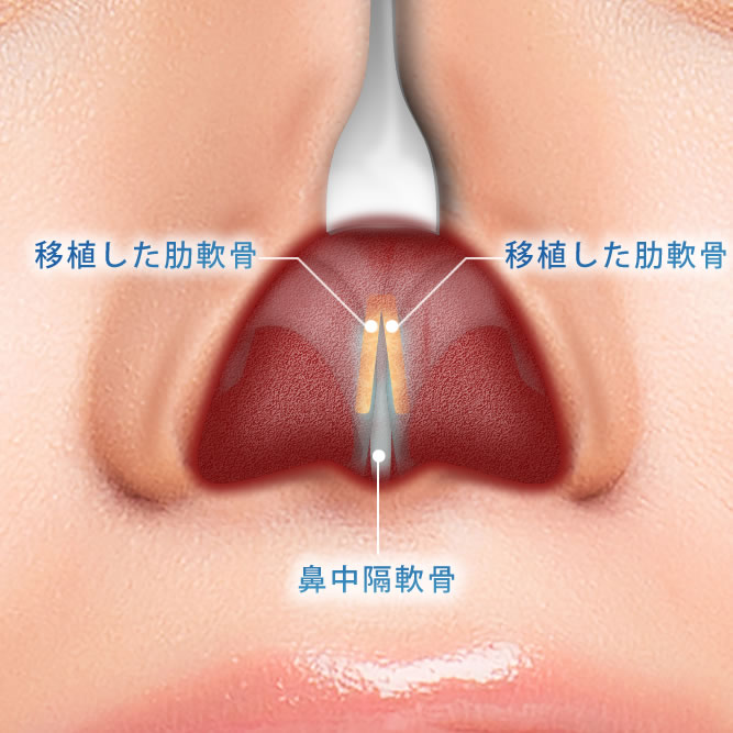 肋軟骨を2枚使った肋軟骨移植の鼻の中の解剖図