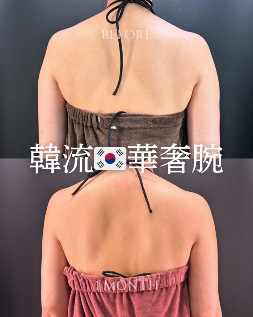 二の腕の脂肪吸引の症例写真 (17)