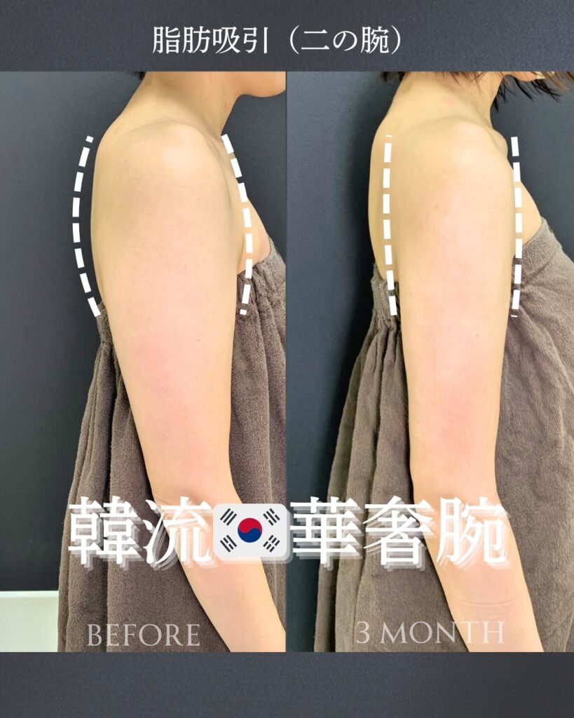 二の腕の脂肪吸引の症例写真 (19)