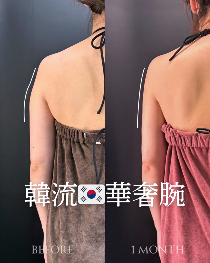 二の腕の脂肪吸引の症例写真 (20)