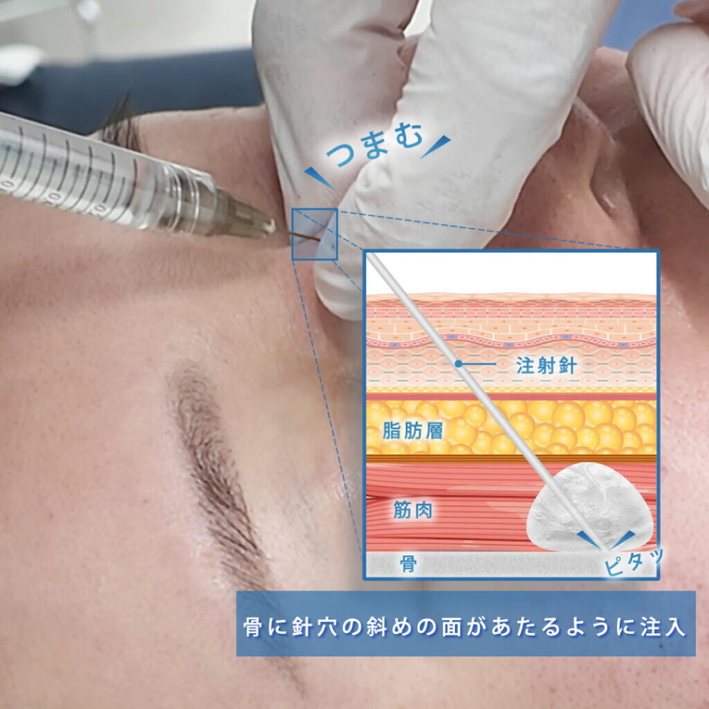 鼻根にヒアルロン酸を注入している様子