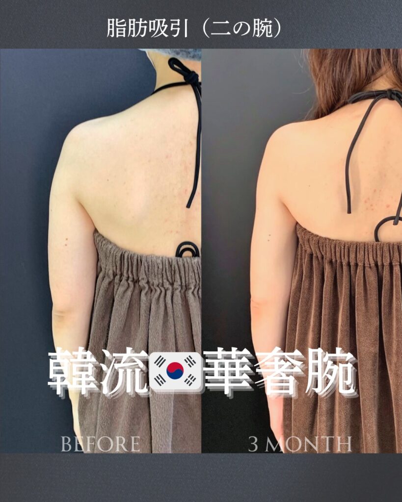 二の腕の脂肪吸引の症例写真 (3)