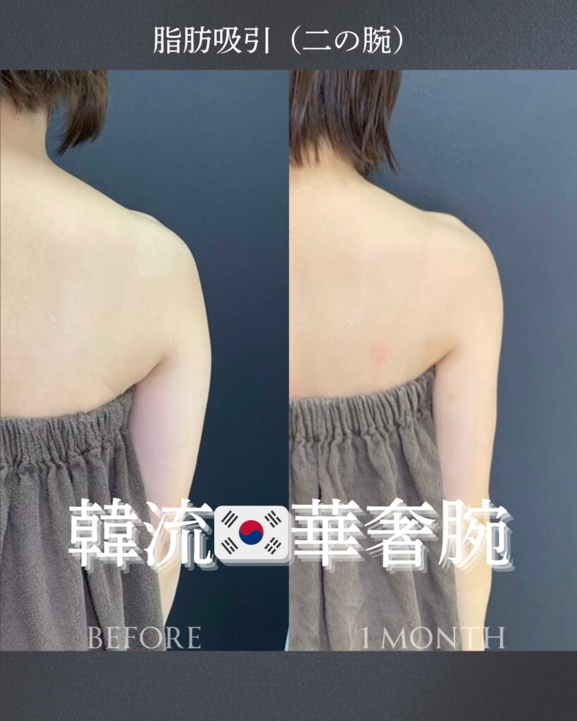 二の腕の脂肪吸引の症例写真 (4)