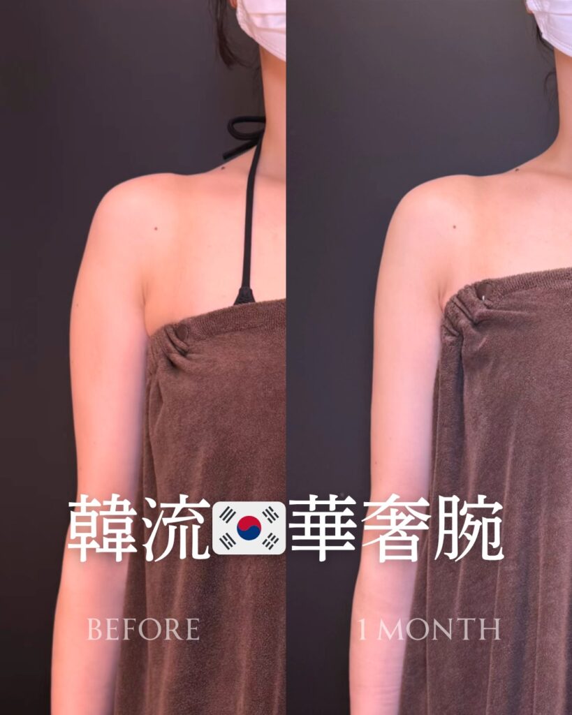 二の腕の脂肪吸引の症例写真 (12)