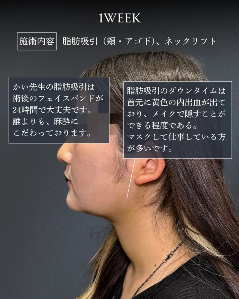 脂肪吸引(頬・顎下)+ネックリフト(加藤快世)