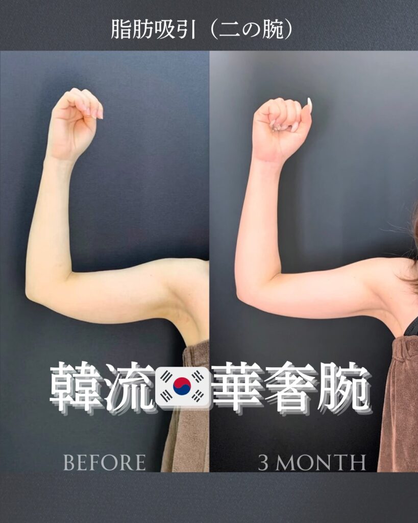二の腕の脂肪吸引の症例写真 (5)