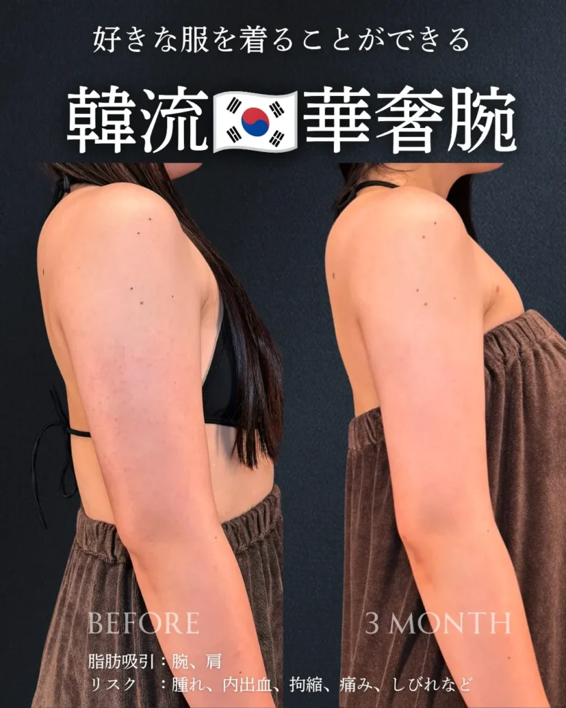 脂肪吸引(二の腕・肩)(加藤快世)