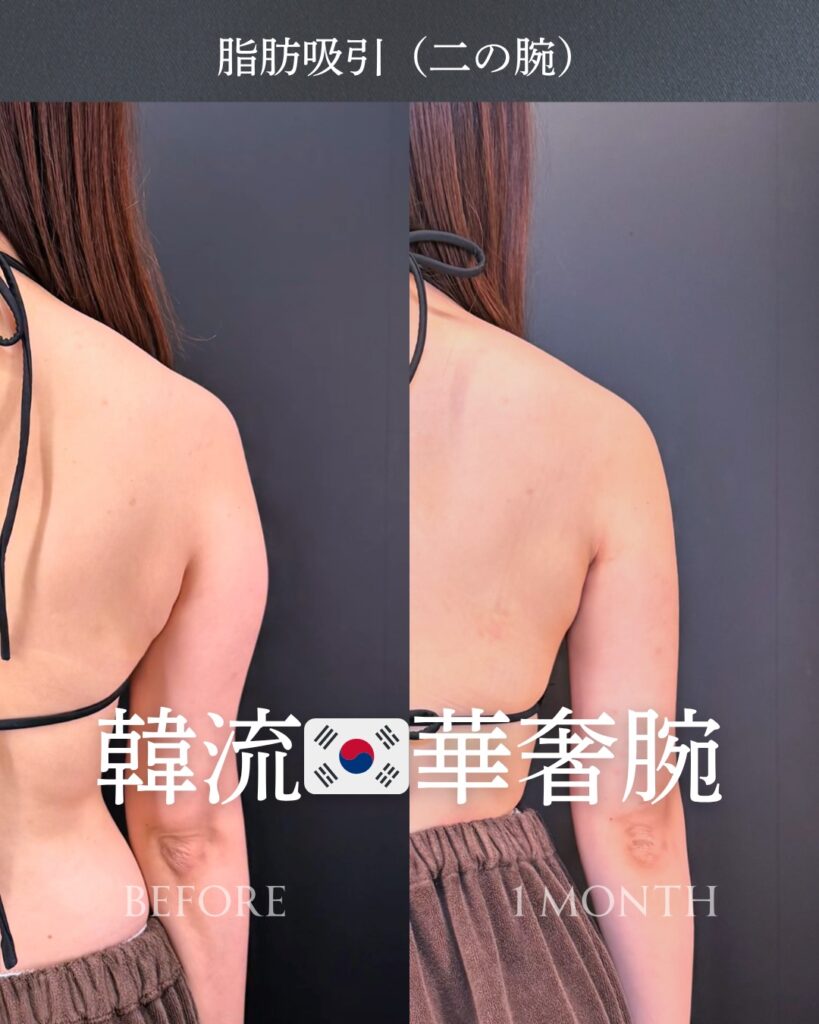 二の腕の脂肪吸引の症例写真 (8)