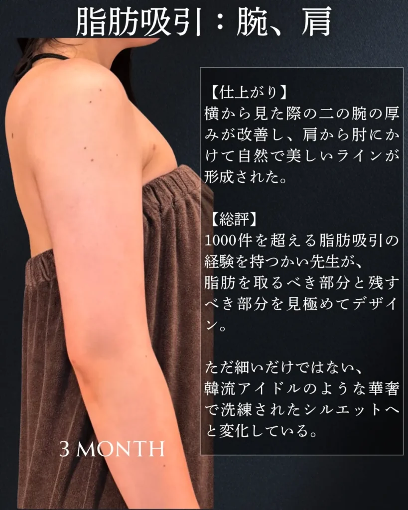 脂肪吸引(二の腕・肩)(加藤快世)