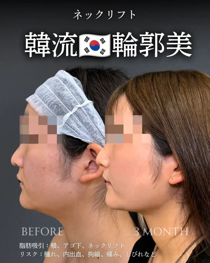 脂肪吸引(頬・顎下)+ネックリフト(加藤快世)