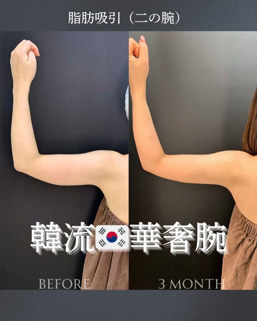 二の腕の脂肪吸引の症例写真 (7)