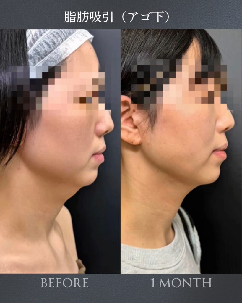 顎下の脂肪吸引の症例写真