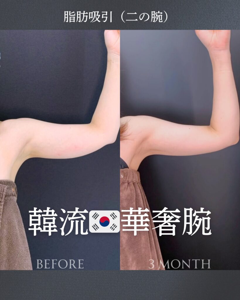 二の腕の脂肪吸引の症例写真